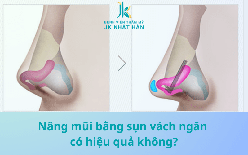 Nâng mũi bằng sụn vách ngăn có hiệu quả không?