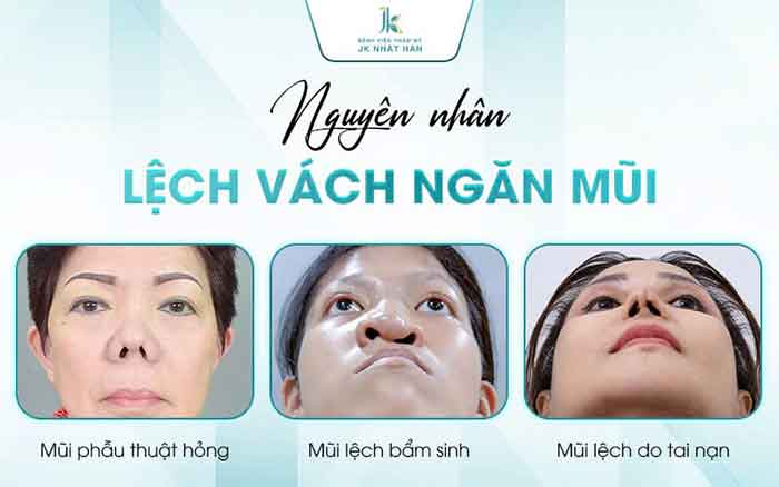 Nguyên nhân gây lệch vách ngăn mũi