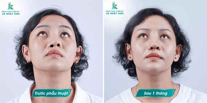 tạo hình chỉnh sửa lệch vách ngăn mũi