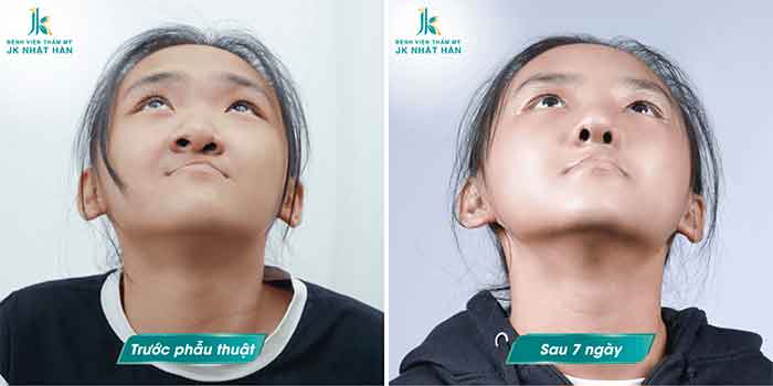 tạo hình chỉnh sửa lệch vách ngăn mũi