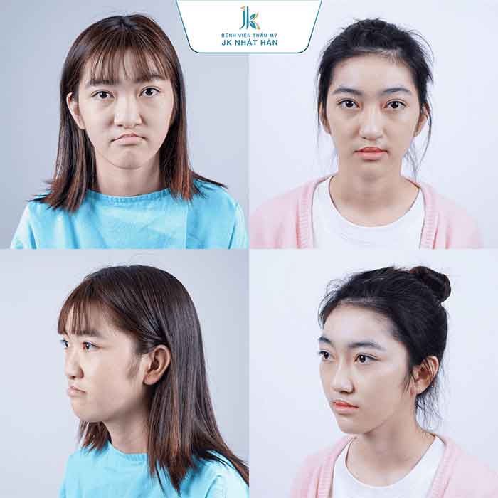 tạo hình chỉnh sửa lệch vách ngăn mũi