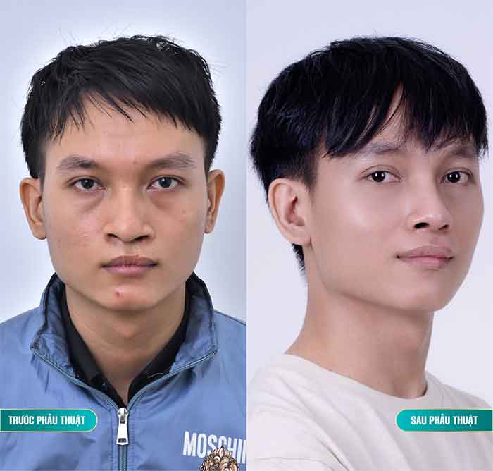 tạo hình chỉnh sửa lệch vách ngăn mũi