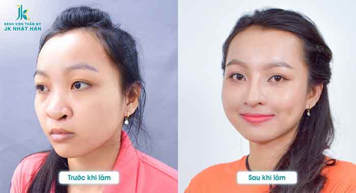 tạo hình chỉnh sửa lệch vách ngăn mũi