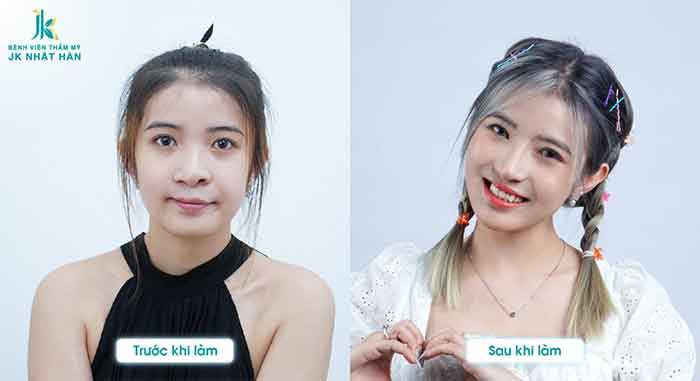 tạo hình chỉnh sửa lệch vách ngăn mũi