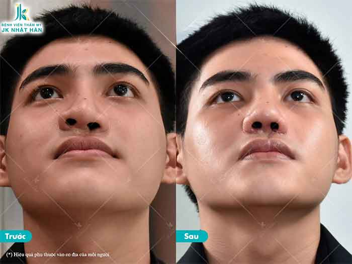 tạo hình chỉnh sửa lệch vách ngăn mũi