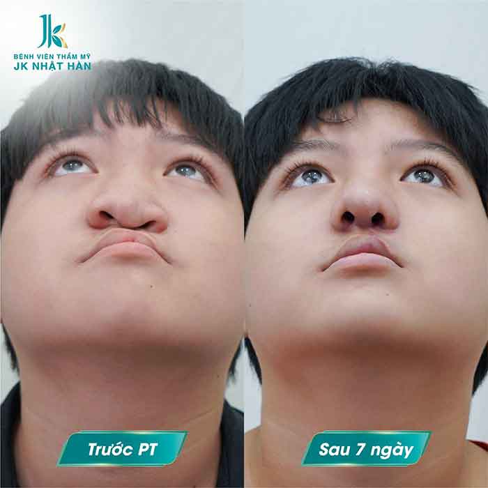 tạo hình chỉnh sửa lệch vách ngăn mũi