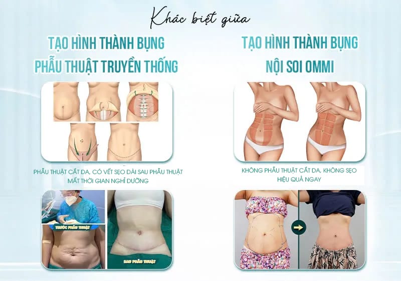 Phụ nữ sau sinh có nên tạo hình thành bụng nội soi không?