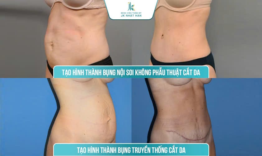 Kết quả sau khi tạo hình thành bụng nội soi không để lại vết sẹo dài như phẫu thuật truyền thống