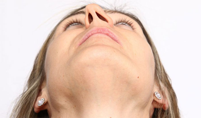 Tình trạng lệch vách ngăn mũi