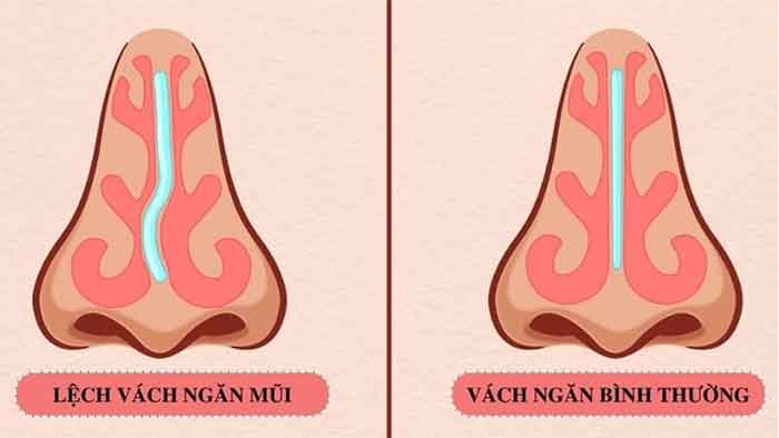 Hình ảnh vách ngăn bình thường và vách ngăn bị lệch