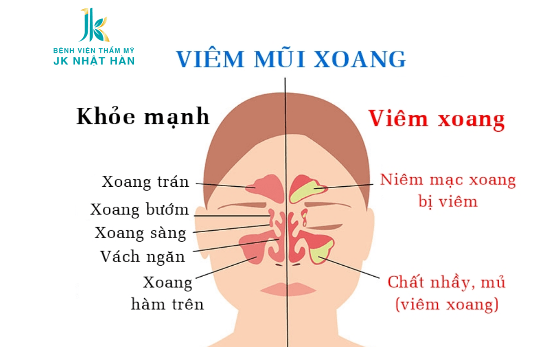 Một số bệnh lý liên quan đến vách ngăn mũi