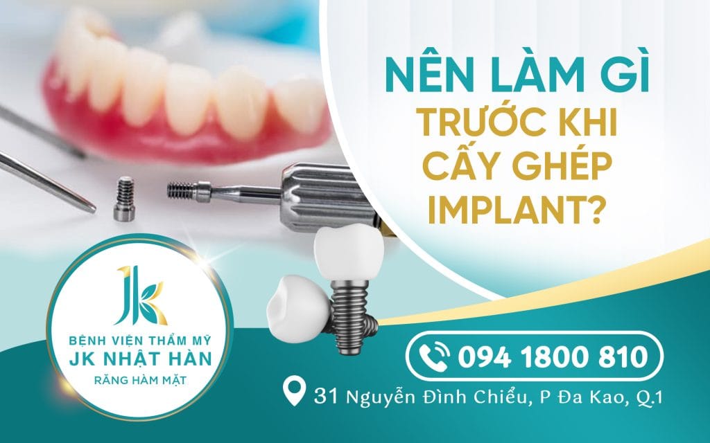 nen-lam-gi-truoc-khi-cay-ghep-rang-implant