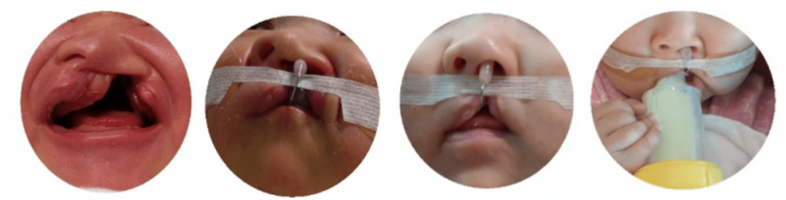 Các phương pháp điều trị trẻ bị hở hàm ếch nói ngọng
