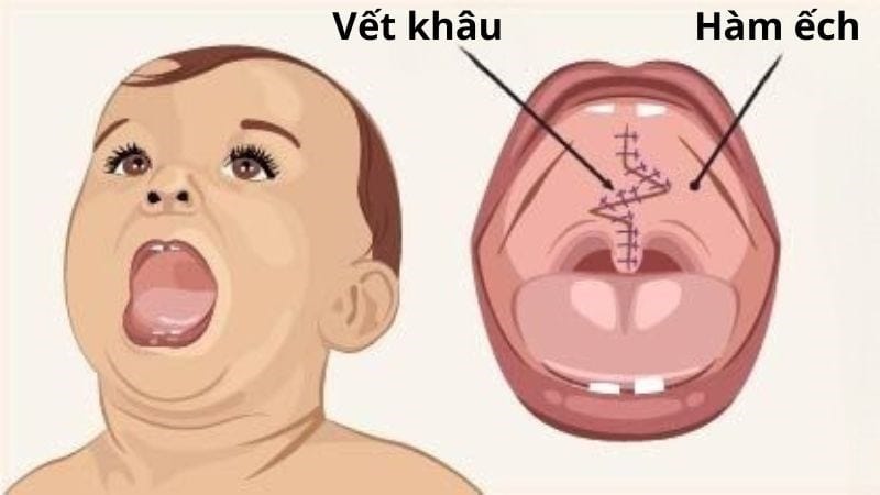Giải pháp điều trị hở hàm ếch trong