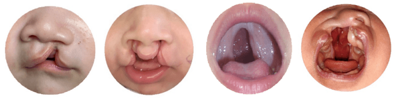 Hiểu đúng về tình trạng trẻ bị hở hàm ếch nói ngọng