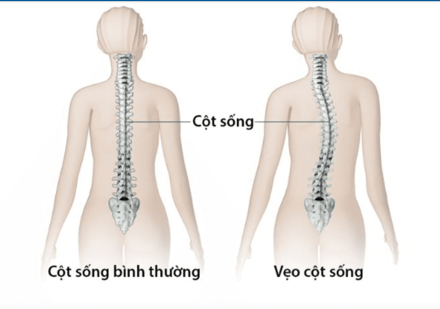 Bệnh sứt môi hở hàm ếch dễ bệnh về cột sống: Có đúng không?