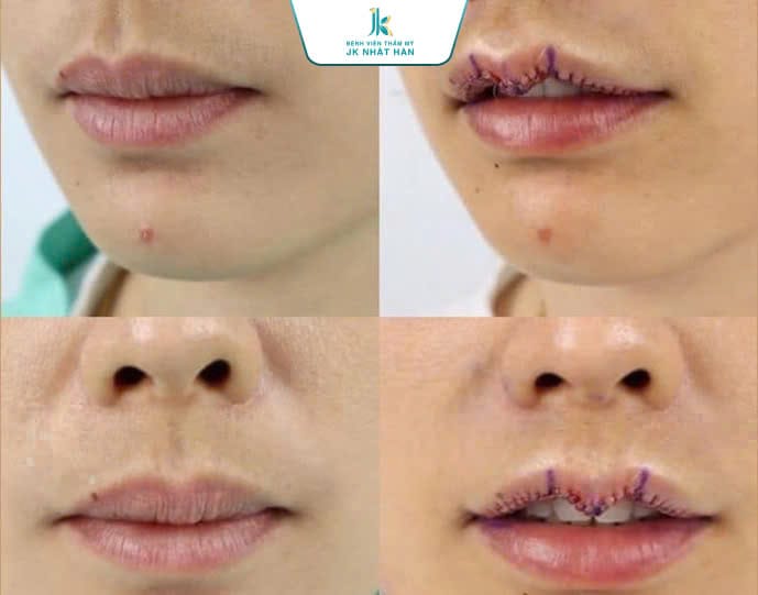 Sửa môi nam: Bí quyết sở hữu đôi môi "quyến rũ" cho nam giới