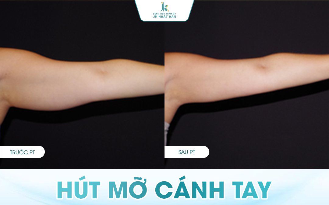 Dịch vụ hút mỡ cánh tay là gì?
