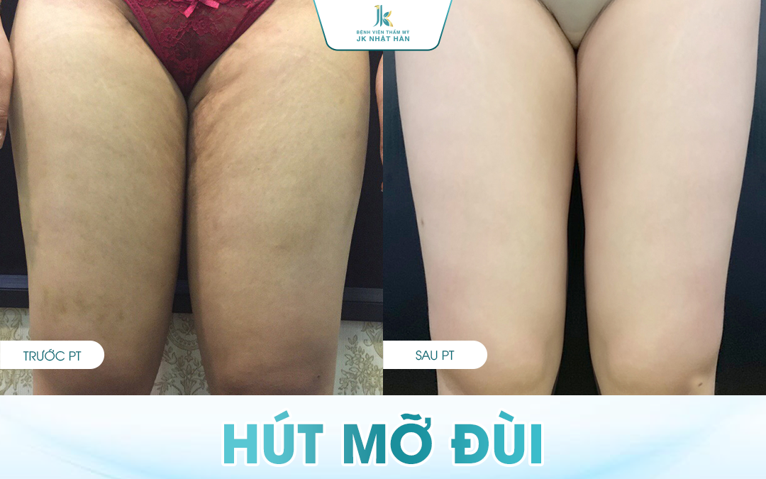 Hút Mỡ Bắp Đùi Giá Bao Nhiêu? Những Yếu Tố Ảnh Hưởng Đến Chi Phí