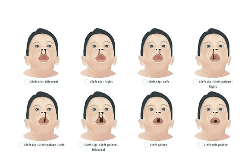 phẫu thuật hở hàm ếch bao nhiêu tiền