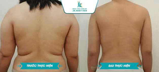 Những ai nên thực hiện hút mỡ xoài lưng?