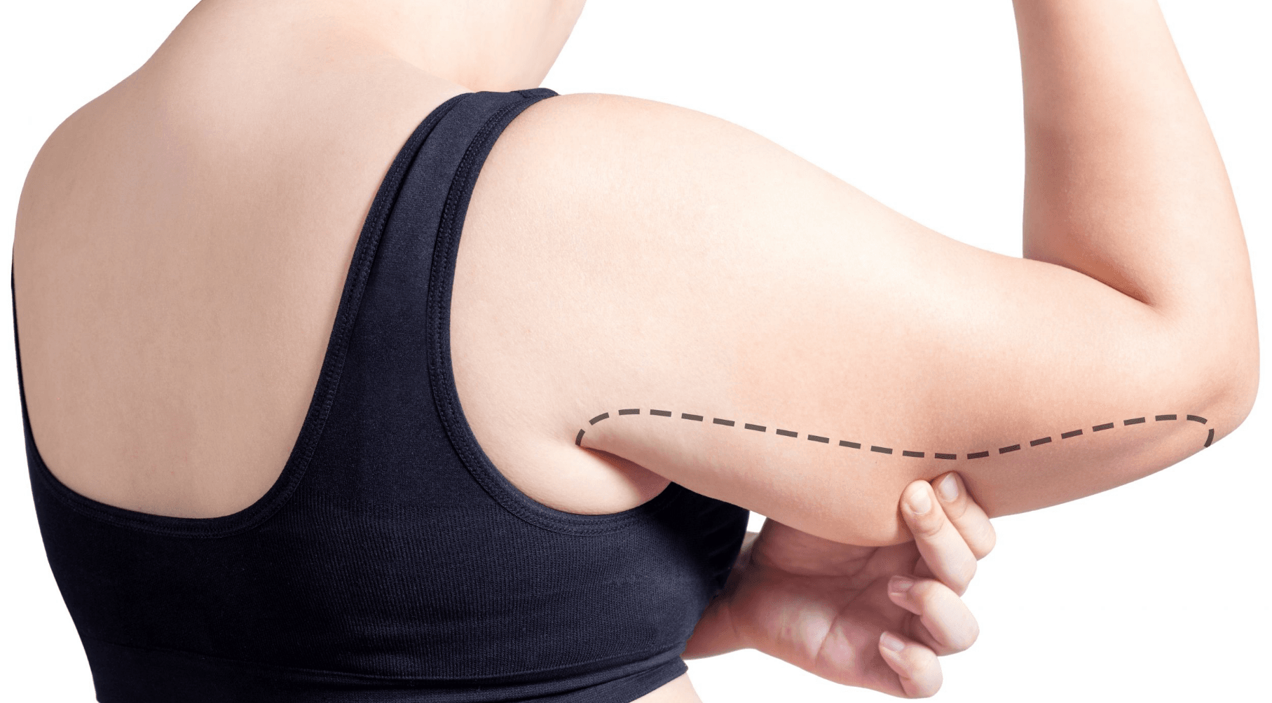 Hút mỡ bắp tay có đau không? Có để lại sẹo xấu không?
