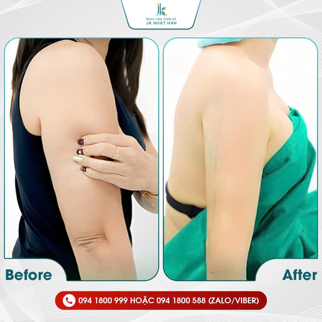 Những ai nên thực hiện hút mỡ cánh tay?