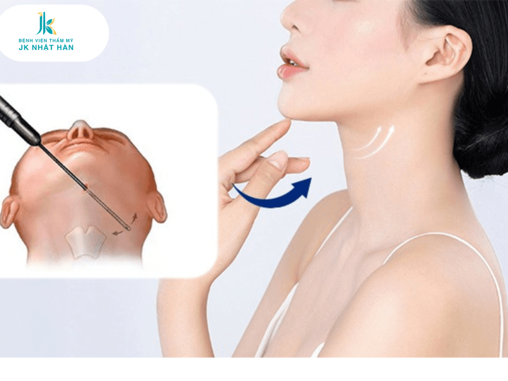 Hút mỡ cổ gáy giá bao nhiêu?