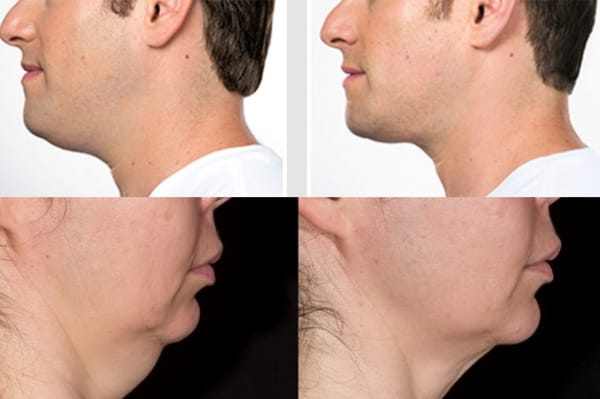 Hút mỡ cổ gáy giá bao nhiêu?