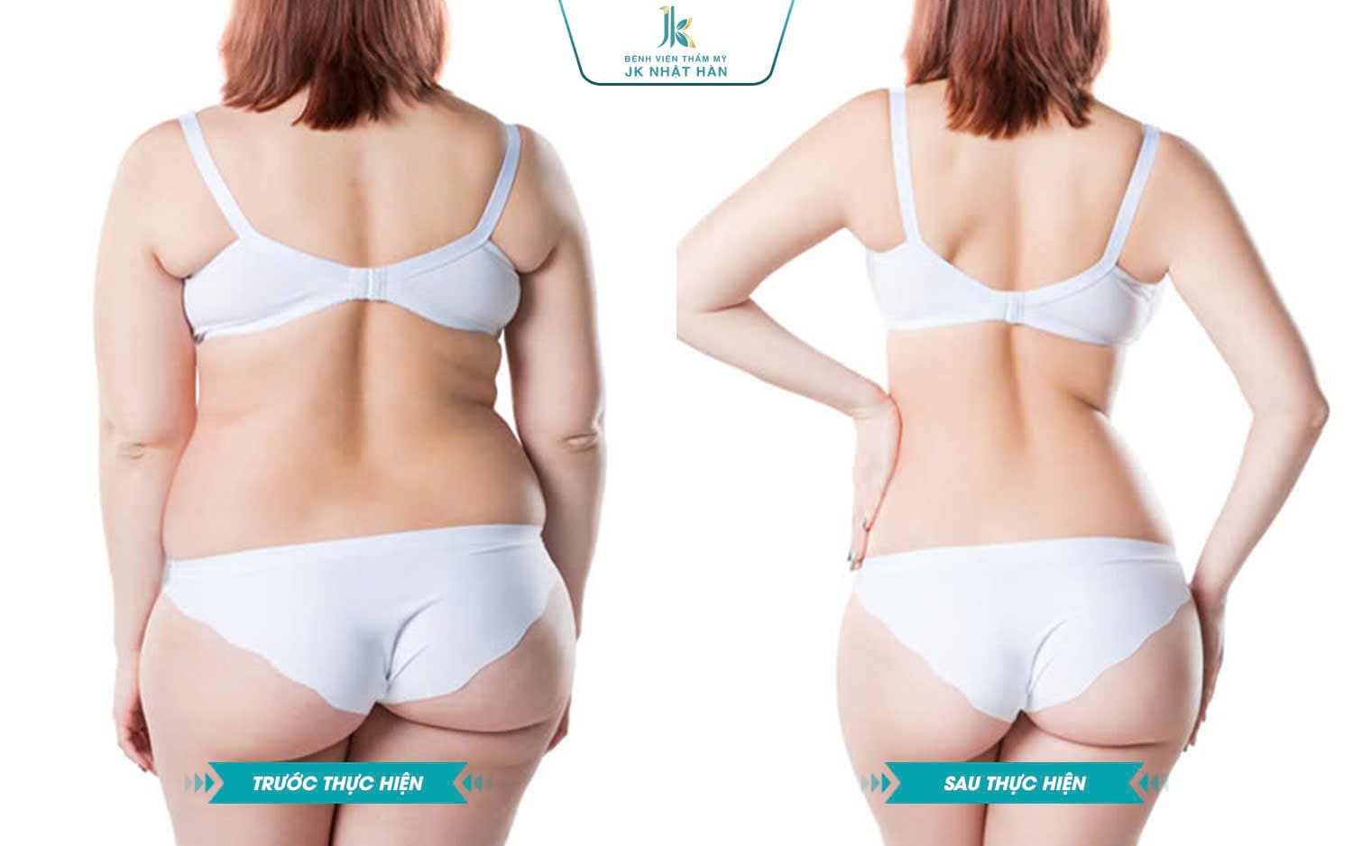 hút mỡ hông là gì