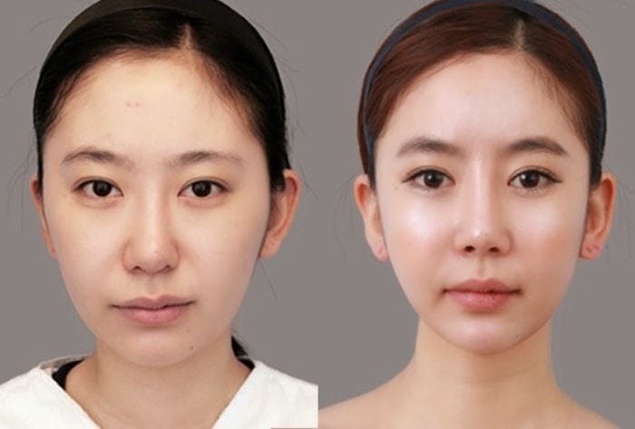 Những điều cần lưu ý trước khi hút mỡ mặt