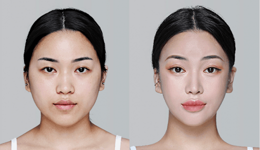 Những điều cần lưu ý trước khi hút mỡ mặt