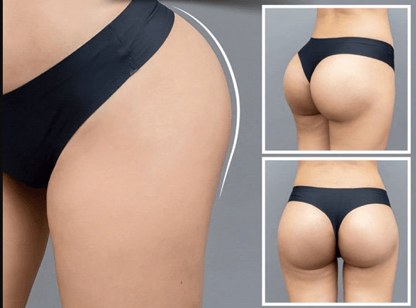 Hút mỡ mông là gì?