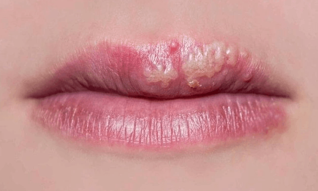 Cách sửa môi xăm hỏng hiệu quả với từng tình trạng môi