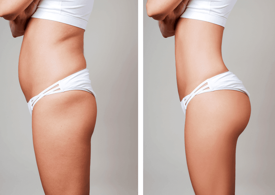 Hút mỡ mông - định hình vòng 3 tại JK Nhật Hàn