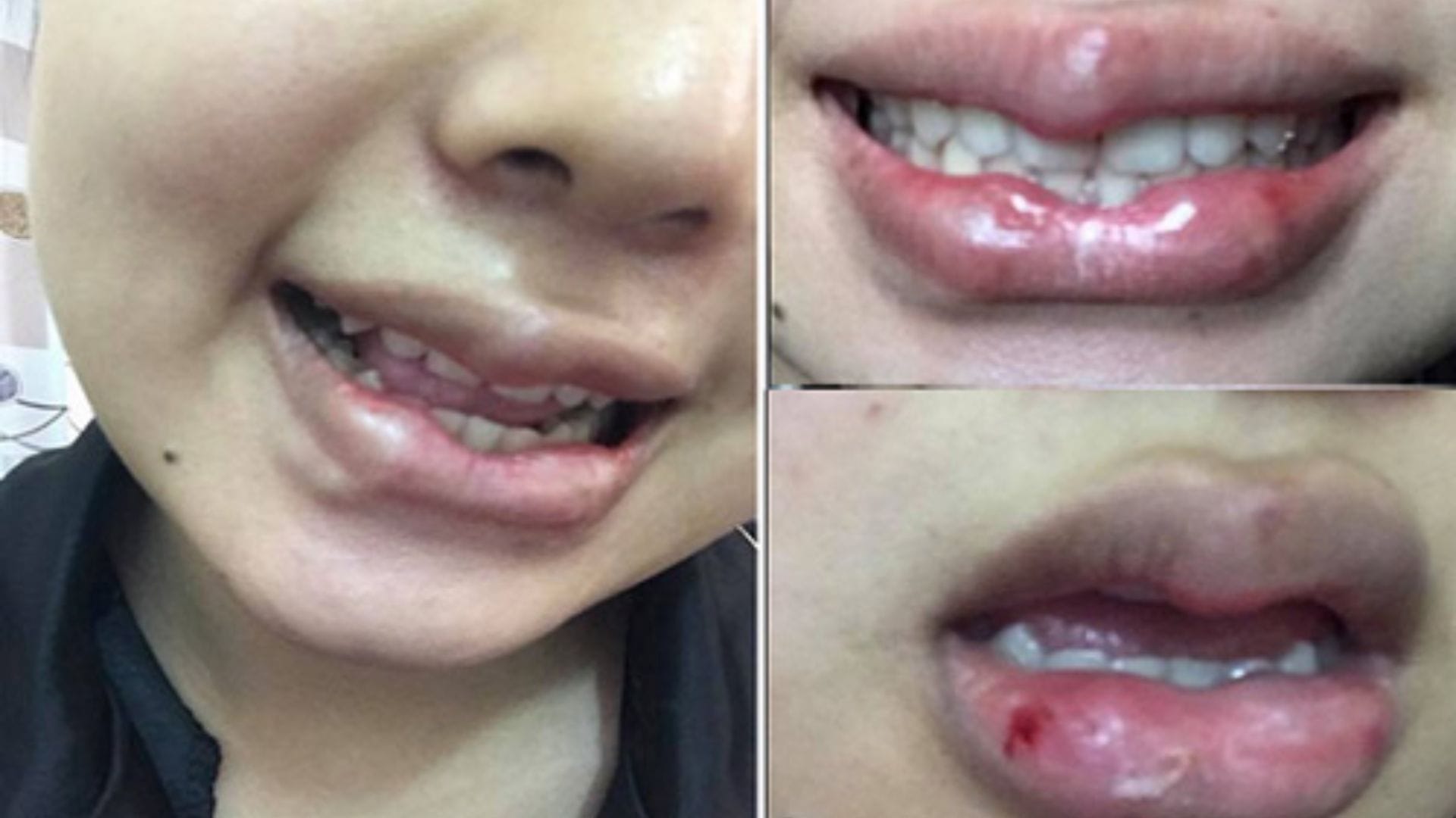 Các dạng môi bị hỏng thường gặp hiện nay