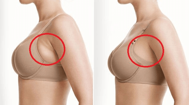 Hút mỡ nách uy tín Sài Gòn