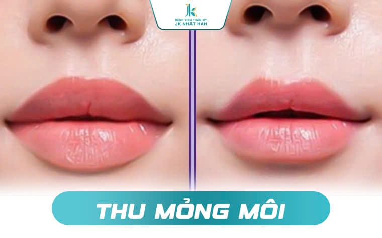 Sửa môi dày có an toàn không?