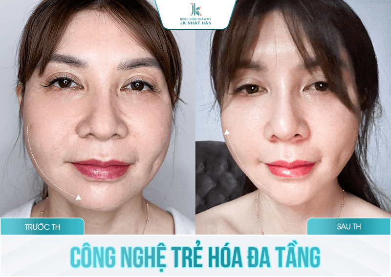 Trẻ hóa da đa tầng