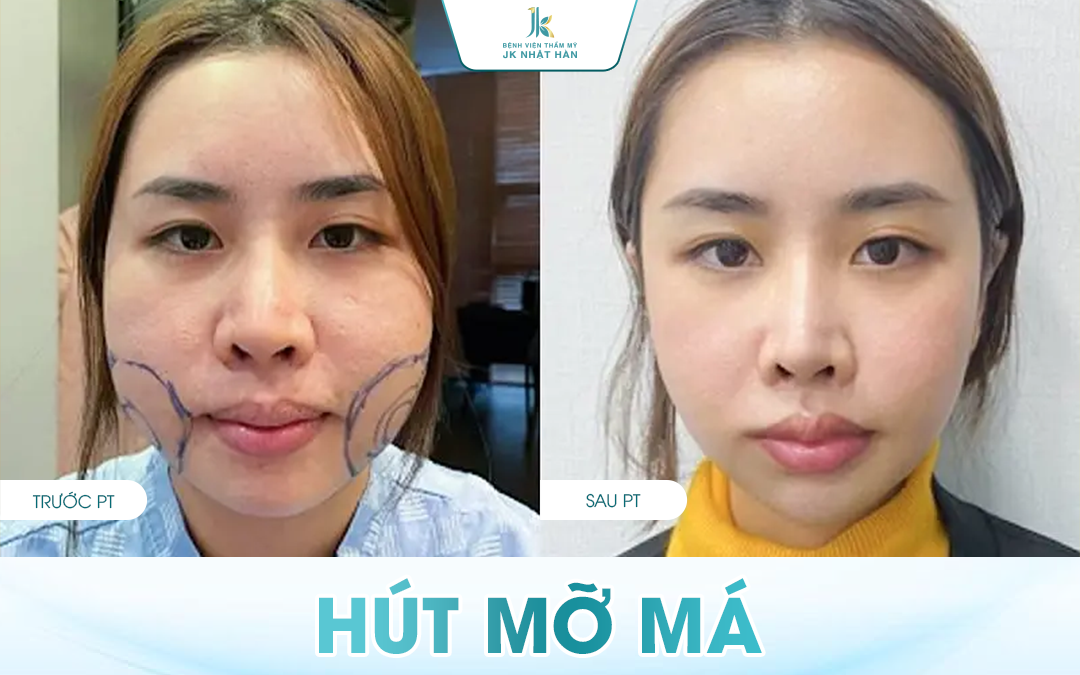 Phẫu thuật Hút mỡ má và những điều cần biết trước khi thực hiện