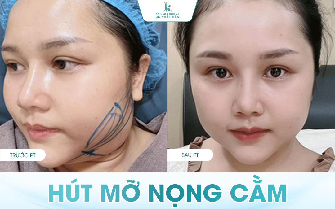 Hút mỡ nọng cằm & Những thông tin làm đẹp bạn cần biết