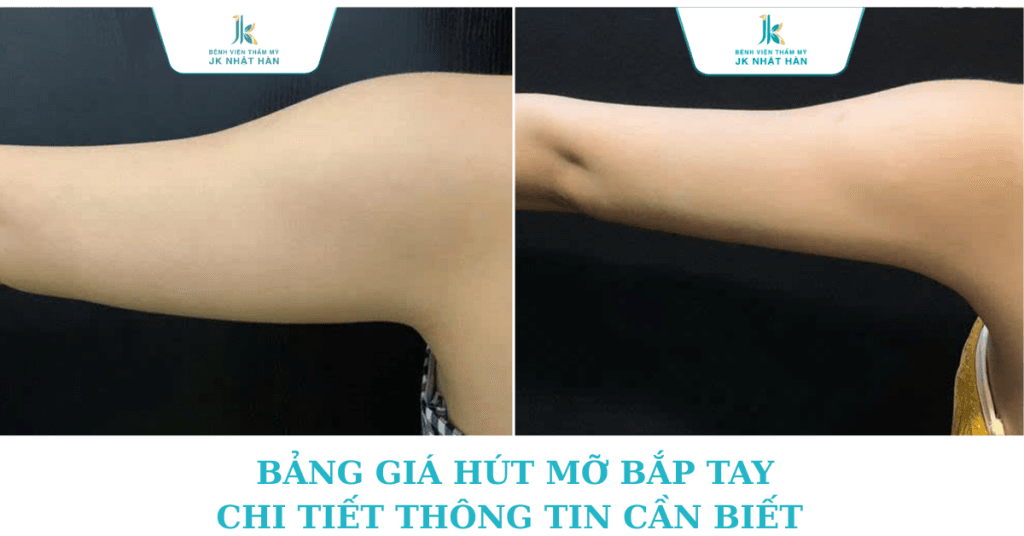 Chi tiết giá Hút mỡ bắp tay