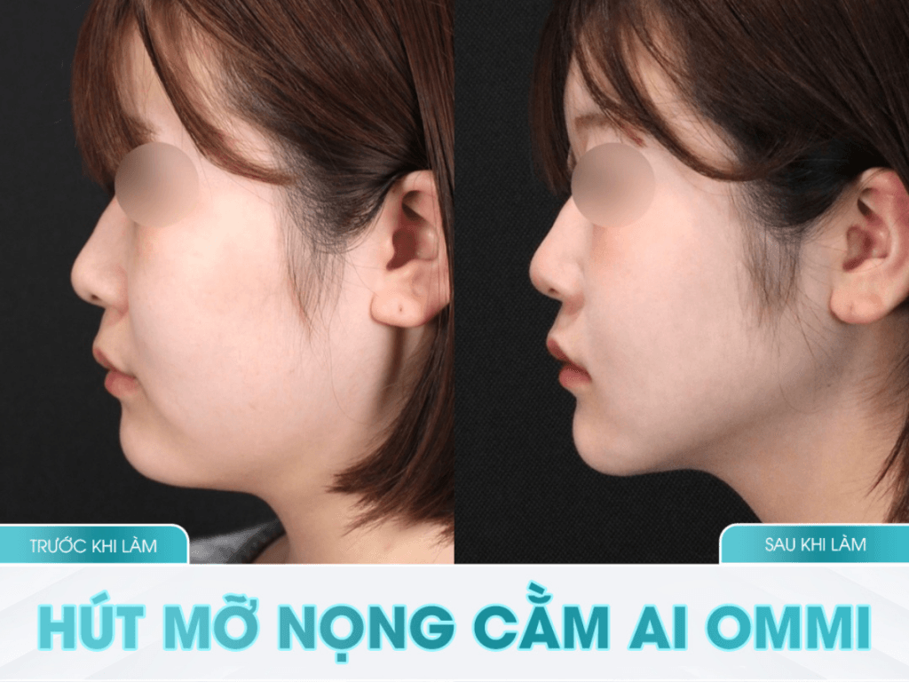 Hút mỡ nọng cằm và những điều bạn cần biết
