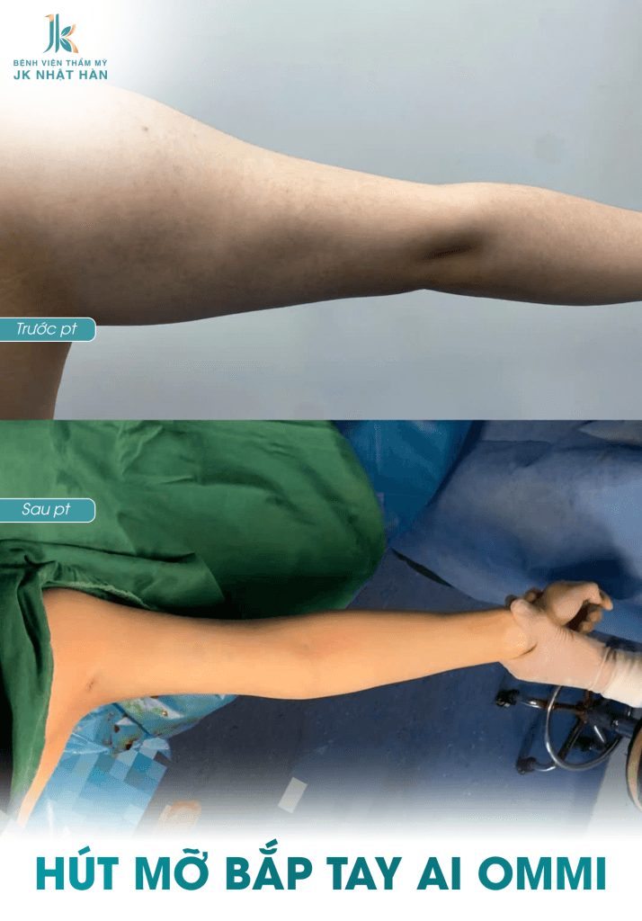 bảng giá hút mỡ bắp tay