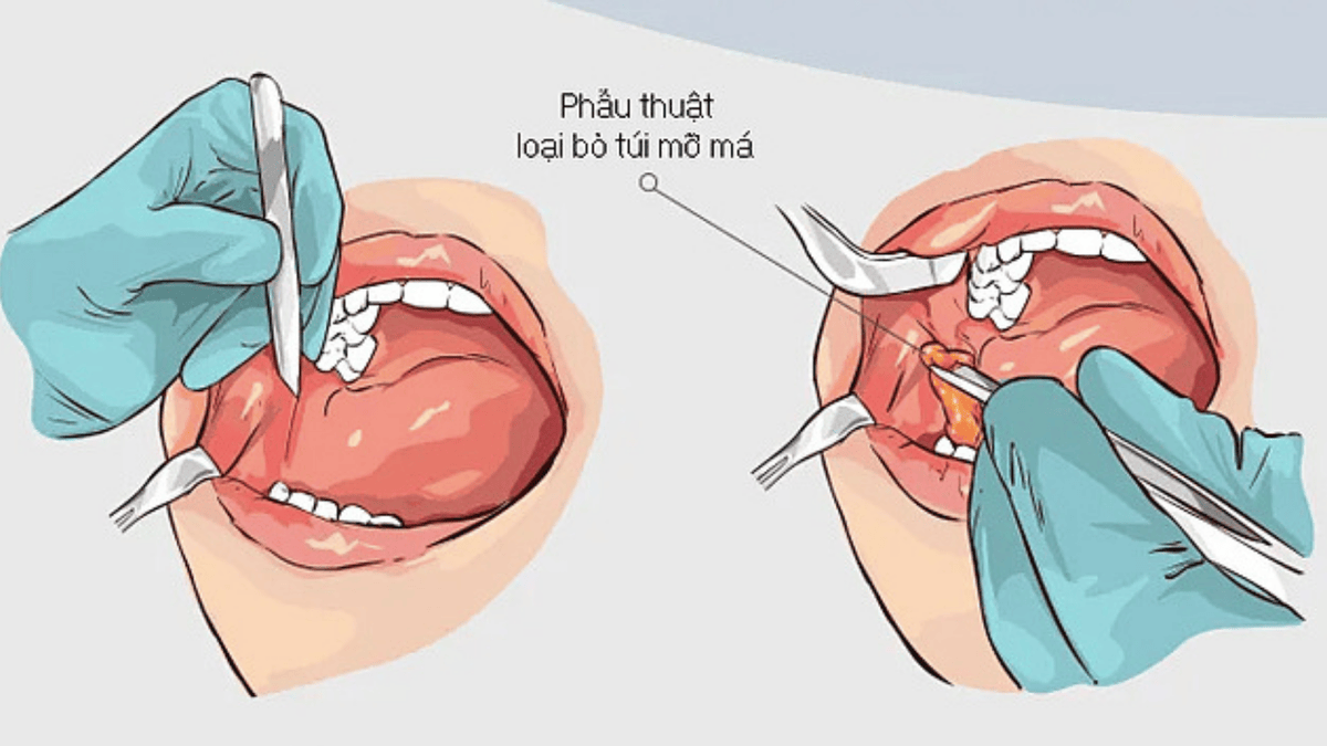 Phẫu thuật Hút mỡ má và những điều cần biết trước khi thực hiện