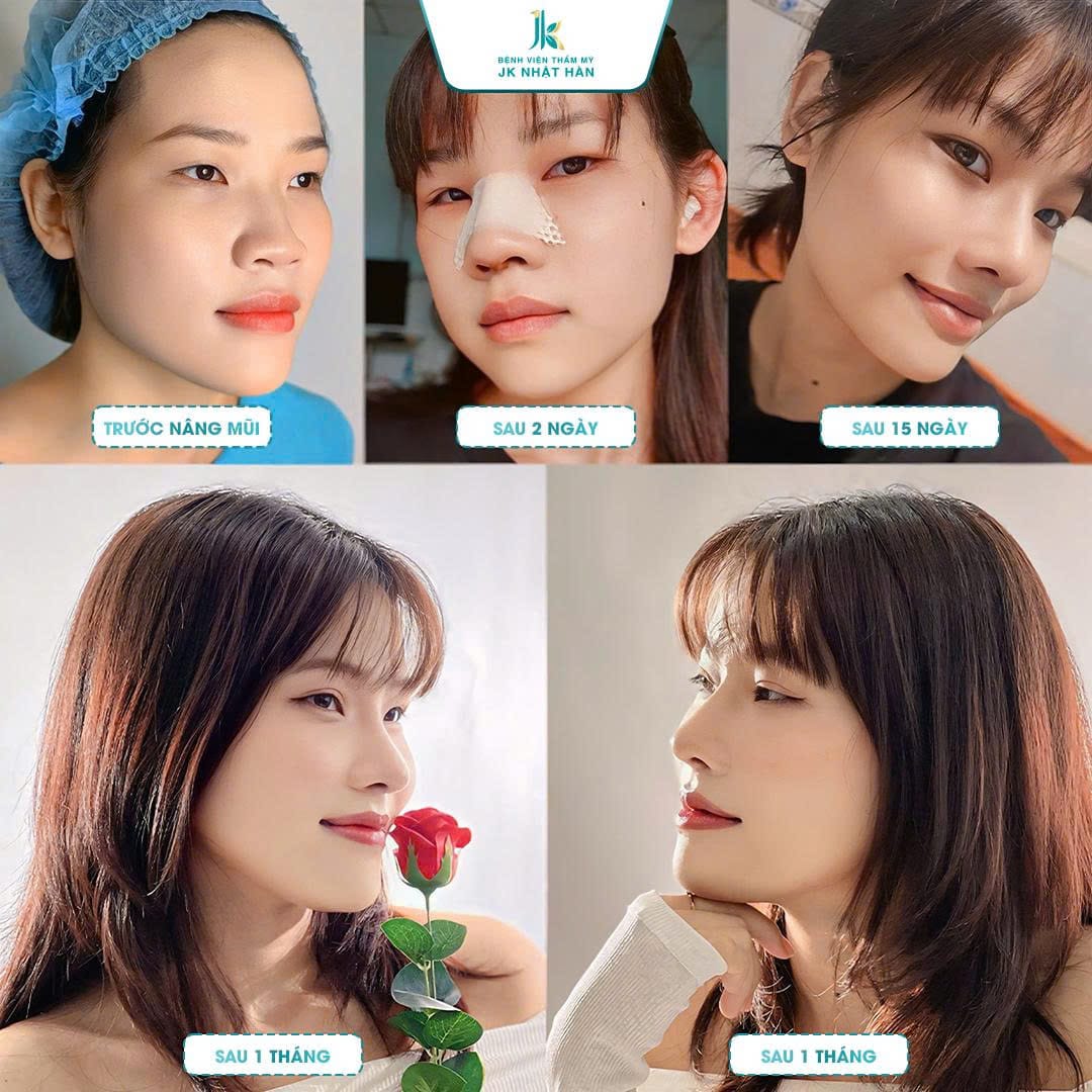 Hình ảnh khách hàng trước và sau khi thực hiện cắt cánh mũi tại JK Nhật Hàn