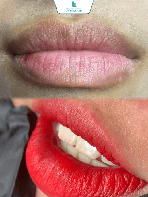 Thẩm mỹ môi an toàn chuẩn 5* tại JK Nhật Hàn