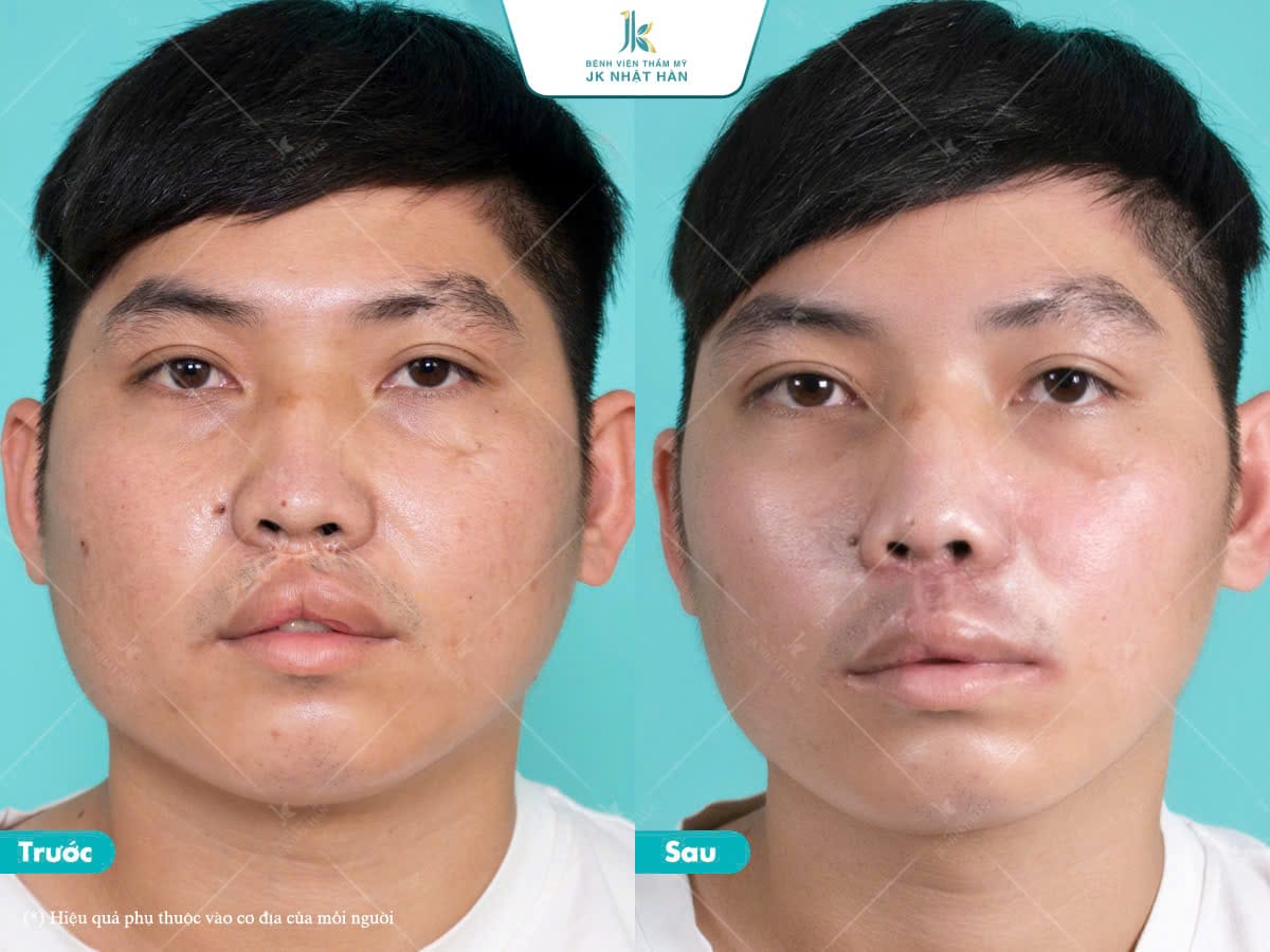 Top 4 giải pháp điều trị sẹo ở môi trên hiệu quả nhất hiện nay