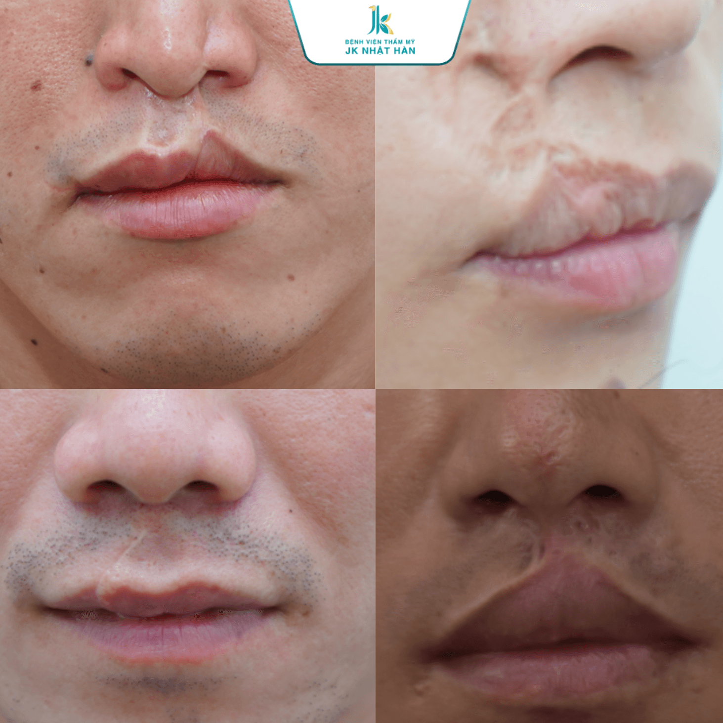 Giải pháp điều trị sẹo ở môi trên hiệu quả nhất