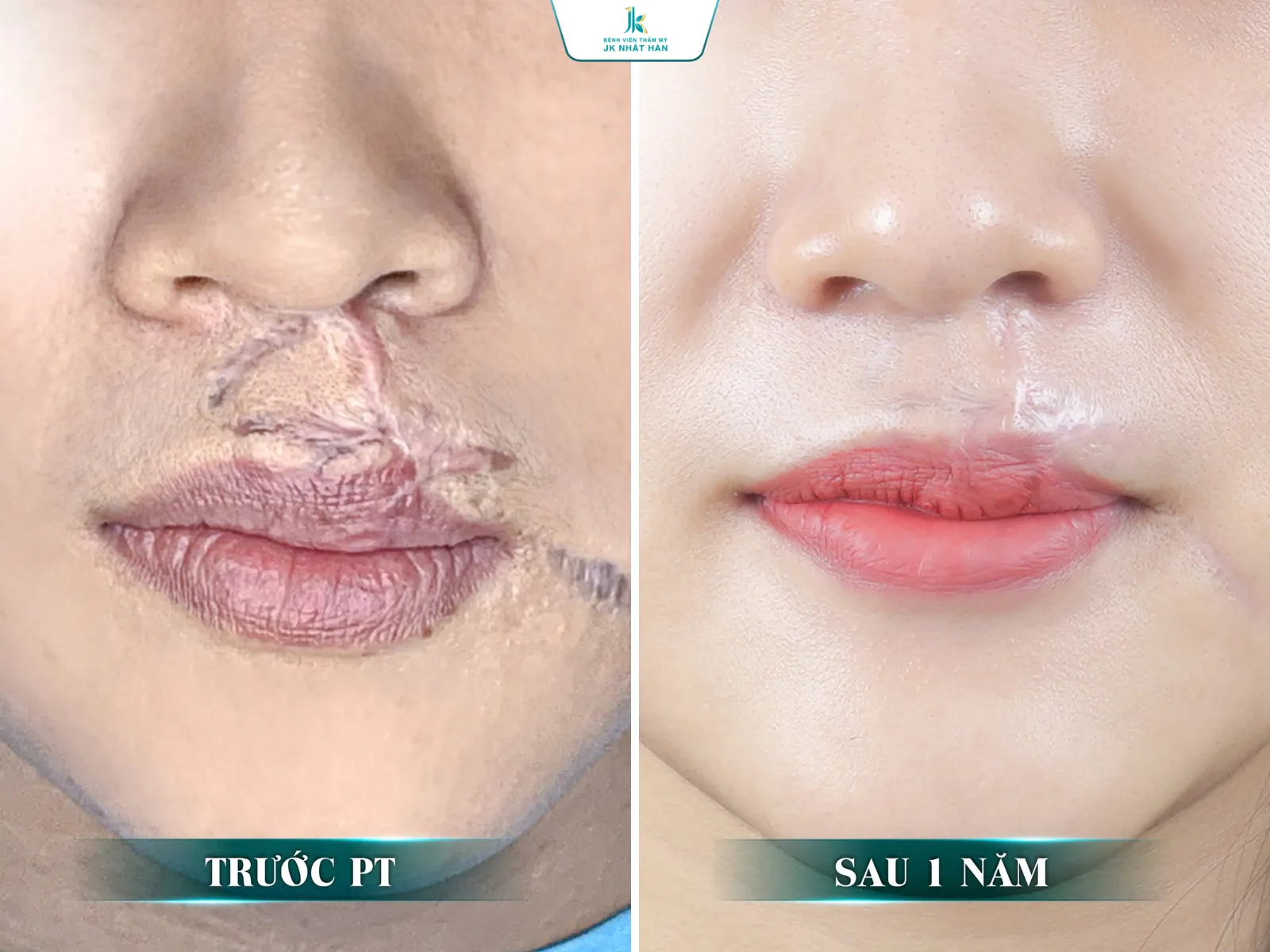 sửa môi có tốt không?